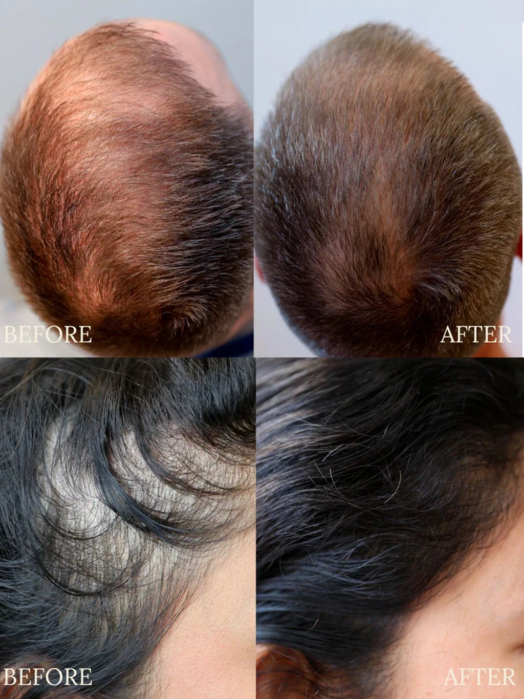 Anti Hair Loss Duo, set produktů